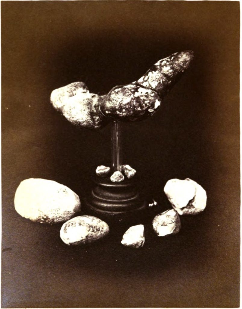 Bladder and urethral calculi photographed for a medical journal in 1870