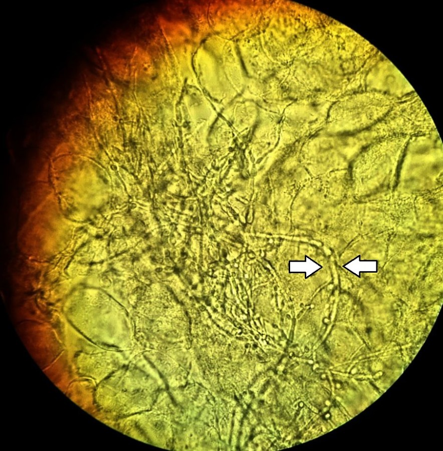 Esame a fresco con idrossido di potassio: pseudoife di Candida albicans fra le cellule vaginali, indicate dalle frecce