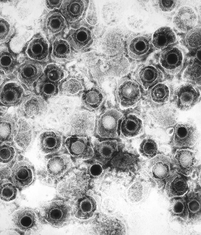 Virioni di herpes simplex al microscopio elettronico a trasmissione