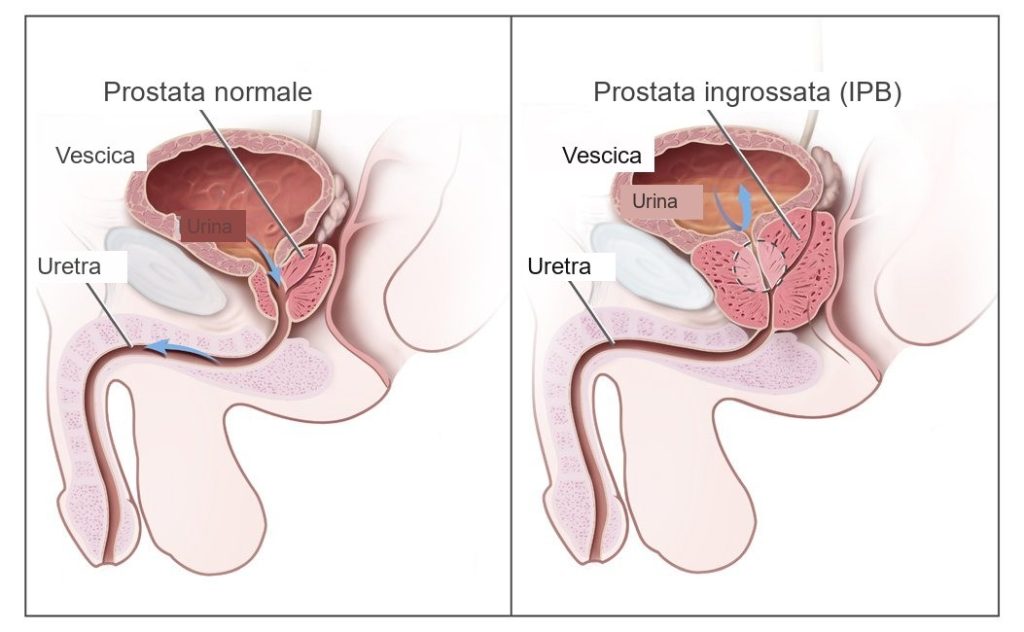 Confronto fra prostata normale e prostata ingrossata che comprime l'uretra, con l'urina trattenuta in vescica